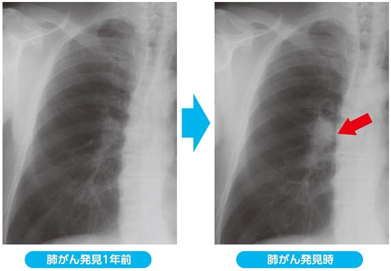 ドック胸部X線検査_表2.jpg