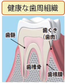 歯周病について｜健康トピックス｜新着情報｜新潟ウェルネス